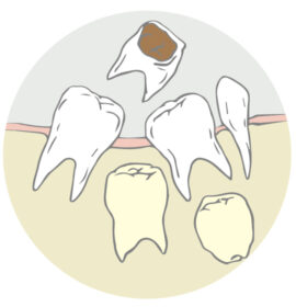 乳歯の虫歯